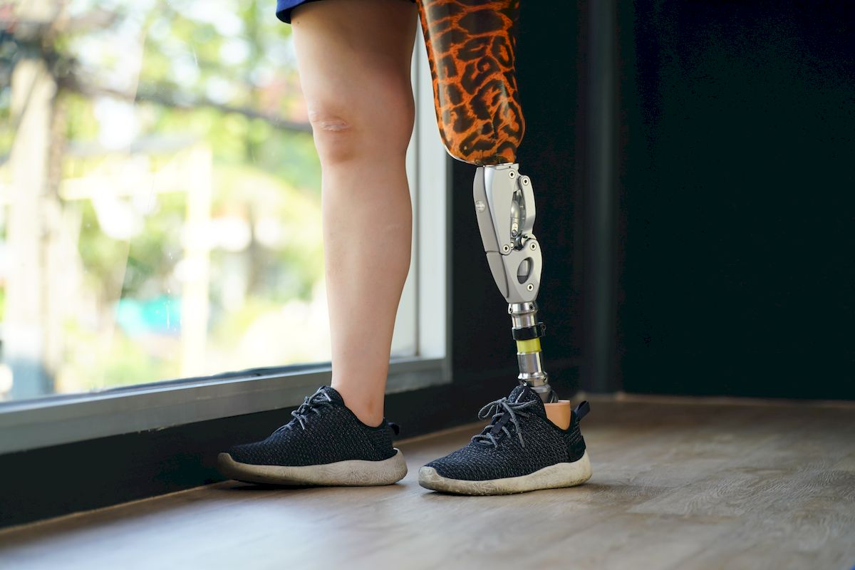 Osoba z protezą nogi podczas nauki chodzenia i adaptacji do codziennego poruszania się